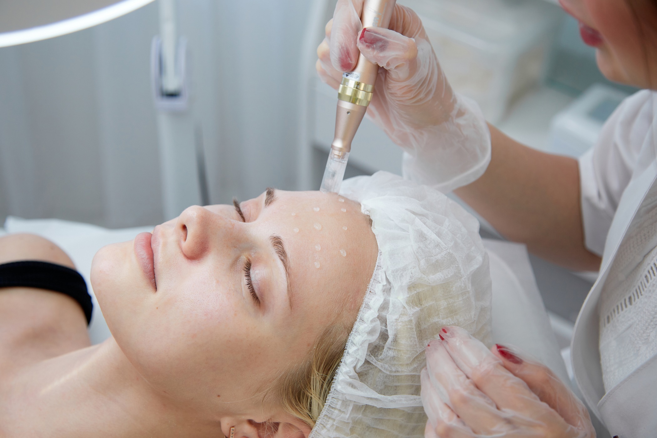 Ihličková alebo bezihlová mezoterapia